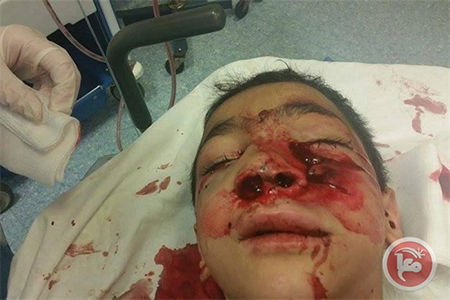 el niño que ha perdido un ojo por el impacto de una bala israel La ocupación sionista hostiga a escolares palestinos